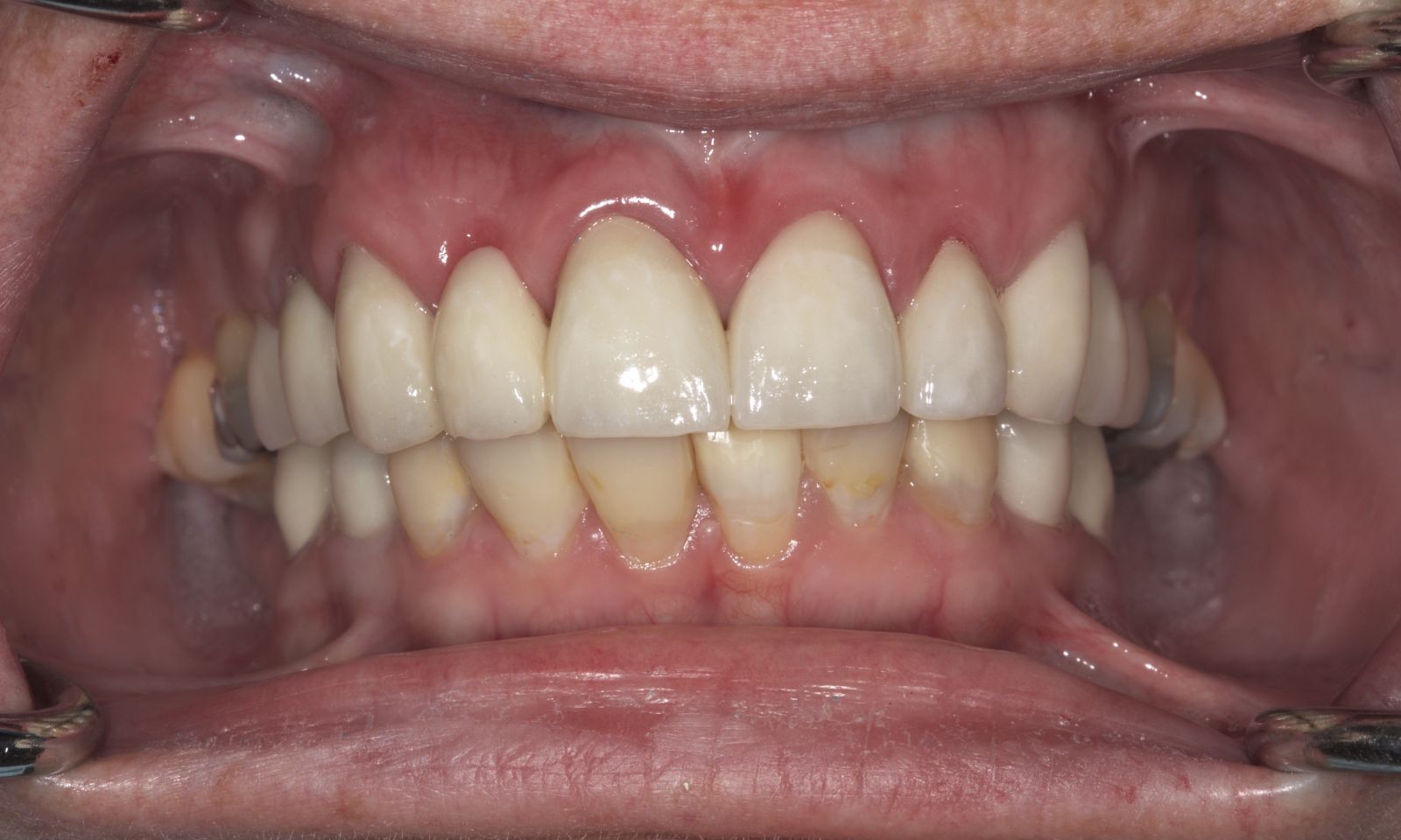 Dental Crowns - After
