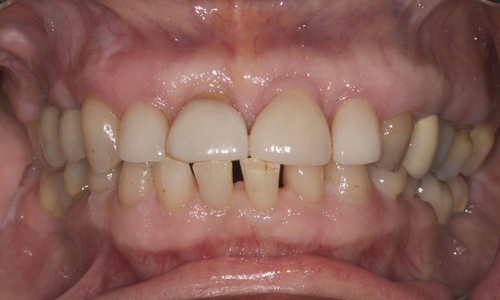 Front Teeth Crowns - Before