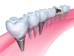 Dental Implants Dothan, AL 
